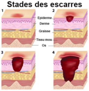 echelle de braden Archives - URPS Auvergne Rhône-Alpes